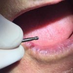 Radiografia de parafuso quebrado no implante