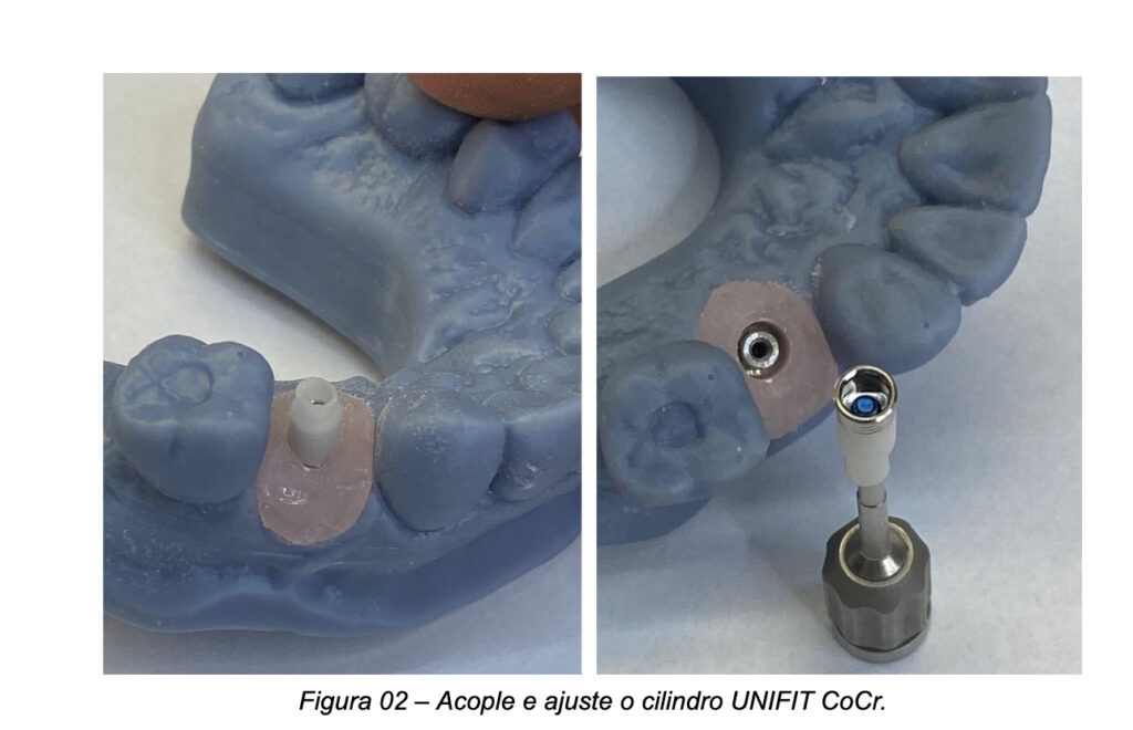 ScanBody acoplado ao Pilar UniFit