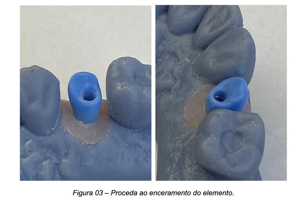 Escaneamento intraoral do Pilar UniFit