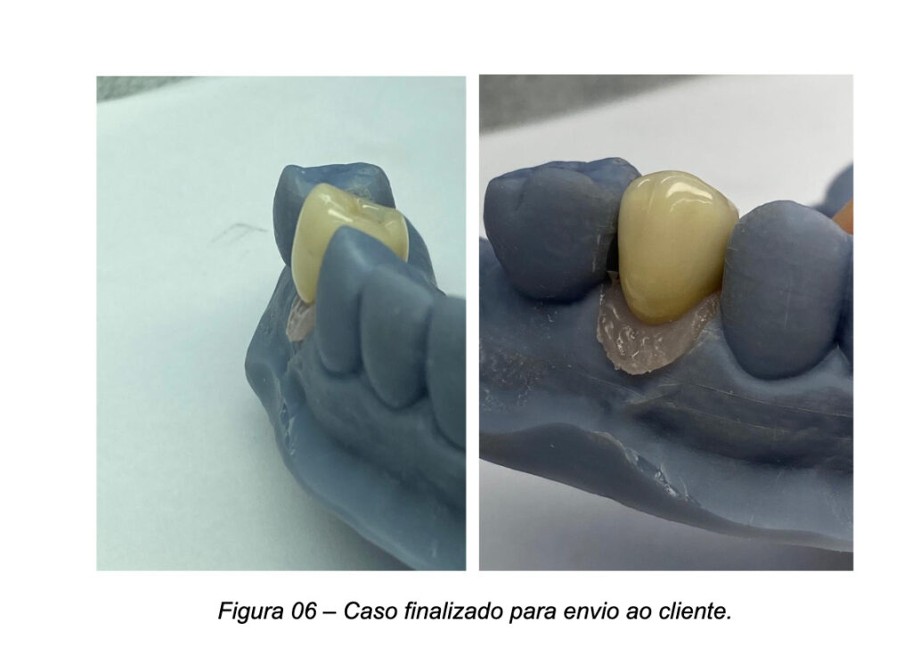 Prova clínica da restauração sobre Pilar UniFit