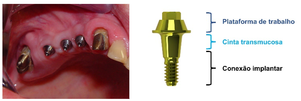 Mini-pilar e componentes protéticos utilizados em próteses sobre implantes
