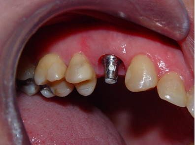 Prótese provisória utilizada para condicionamento de tecidos sobre implante